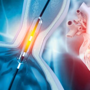 ANGIOPLASTIA TRANSLUMINAL PERCUTÂNEA DE BIFURCAÇÃO E DE TRONCO COM IMPLANTE DE STENT