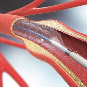 ANGIOPLASTIA TRANSLUMINAL PERCUTANEA DE MULTIPLOS VASOS