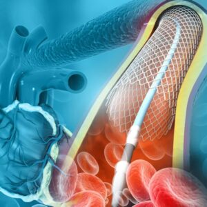 ANGIOPLASTIA TRANSLUMINAL PERCUTÂNEA DE MÚLTIPLOS VASOS COM IMPLANTE DE STENT