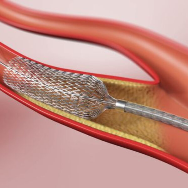 ANGIOPLASTIA CAROTIDIA