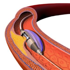 ATEROMECTOMIA ROTACIONAL DIRECIONAL EXTRACIONAL OU USO DE LASER CORONARIANO COM OU SEM ANGIOPLASTIA POR BALÃO COM OU SEM IMPLANTE DE STENT