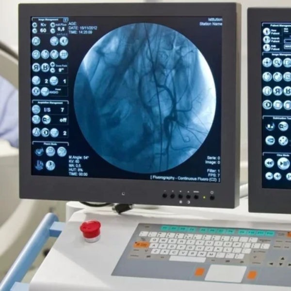 Angiografia por cateterismo seletivo de ramo primário por vaso é um procedimento médico utilizado para avaliar diretamente um vaso sanguíneo específico no corpo. Durante o procedimento, um cateter é inserido em uma artéria e direcionado até o vaso sanguíneo a ser examinado. Em seguida, é injetado um contraste especial que permite a visualização detalhada desse vaso sanguíneo por meio de imagens de raio-X em tempo real. Esse exame é útil para diagnosticar condições como estreitamentos, bloqueios ou anomalias nos vasos sanguíneos, ajudando os médicos a planejar o tratamento adequado