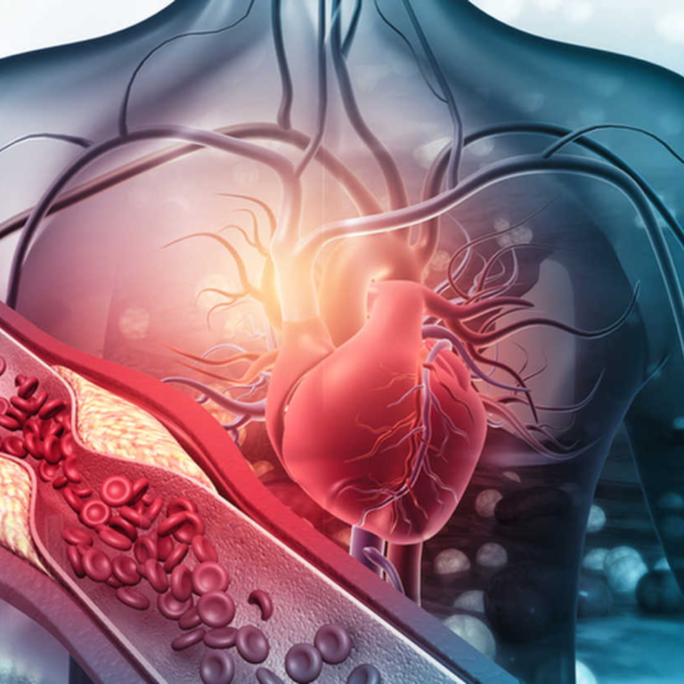 ANGIOPLASTIA TRANSLUMINAL PERCUTÂNEA DE BIFURCAÇÃO E DE TRONCO COM IMPLANTE DE STENT