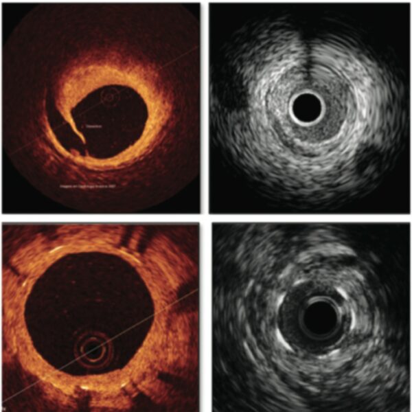 ESTUDO ULTRASSONOGRÁFICO INTRAVASCULAR