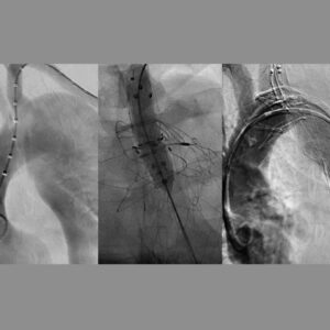 IMPLANTE DE PRÓTESE INTRAVASCULAR NA AORTA/PULMONAR OU RAMOS COM OU SEM ANGIOPLASTIA