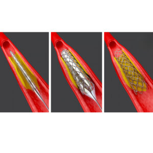 IMPLANTE DE STENT CORONÁRIO COM OU SEM ANGIOPLASTIA POR BALÃO CONCOMITANTE (1 VASO)