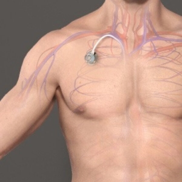 QUIMIOTERAPIA POR CATETER INTRA ARTERIAL