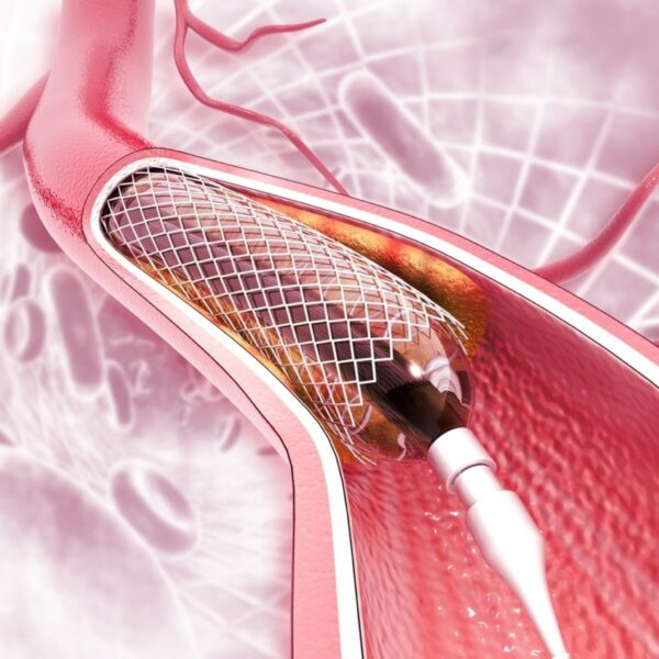 RECANALIZAÇÃO MECÂNICA DO IAM (ANGIOPLASTIA PRIMÁRIA )