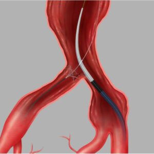 RETIRADA PERCUTÂNEA DE CORPOS ESTRANHOS INTRAVASCULAR