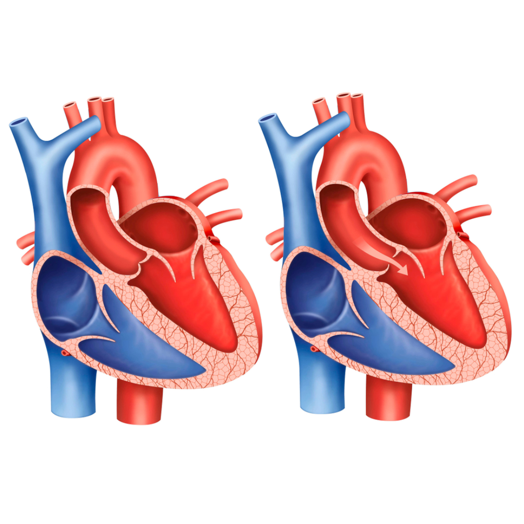 VALVOPLASTIA PERCUTANEA VIA ARTERIAL OU VENOSA